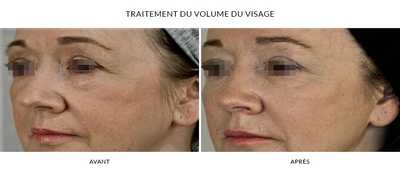 Acide hyaluronique à Paris 16 - Photos avant et après | Dr Chouquet